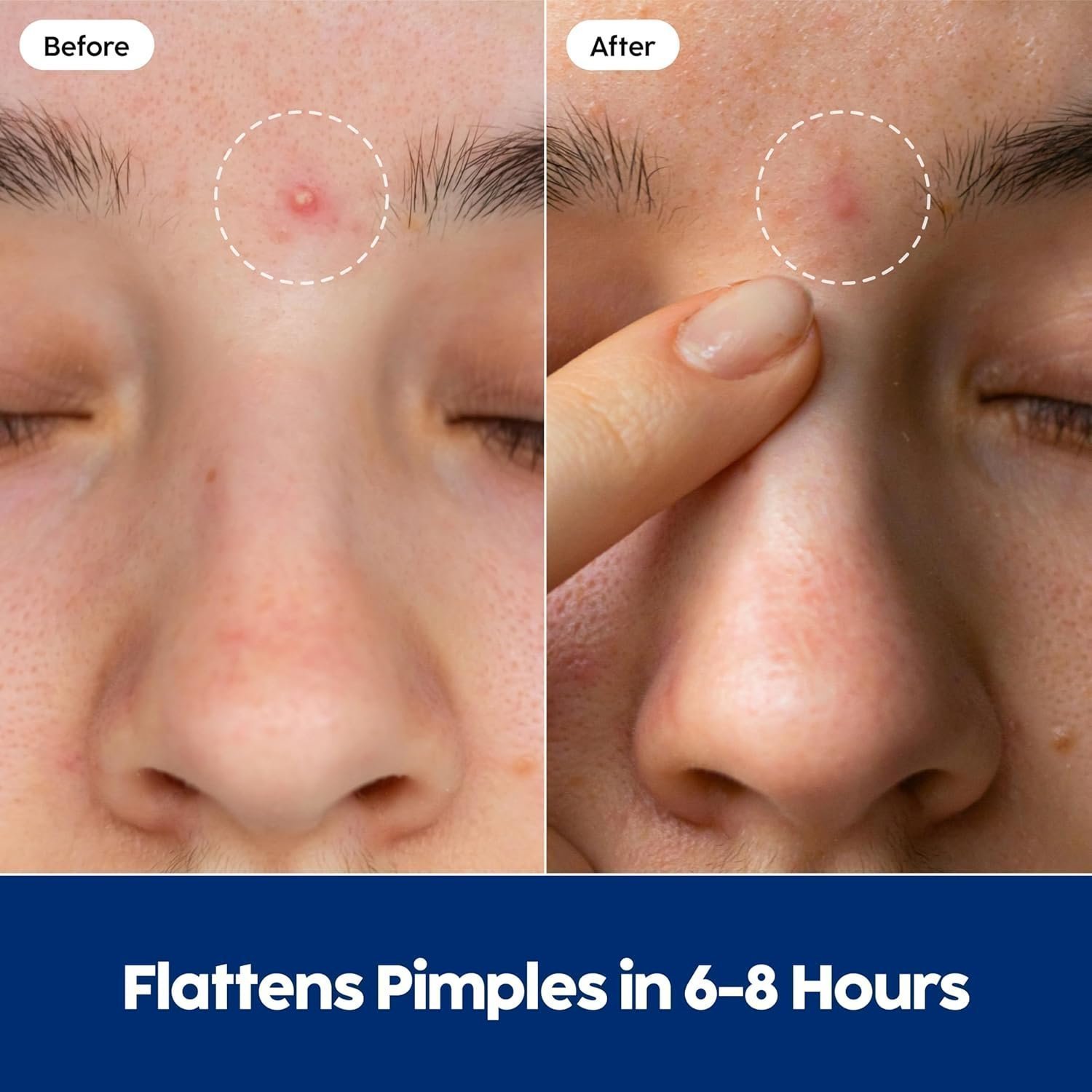 Patch Perfect Spot Patches (102 Count), Vegan & Cruelty-Free Spot Stickers (2 Sizes) - Image 5